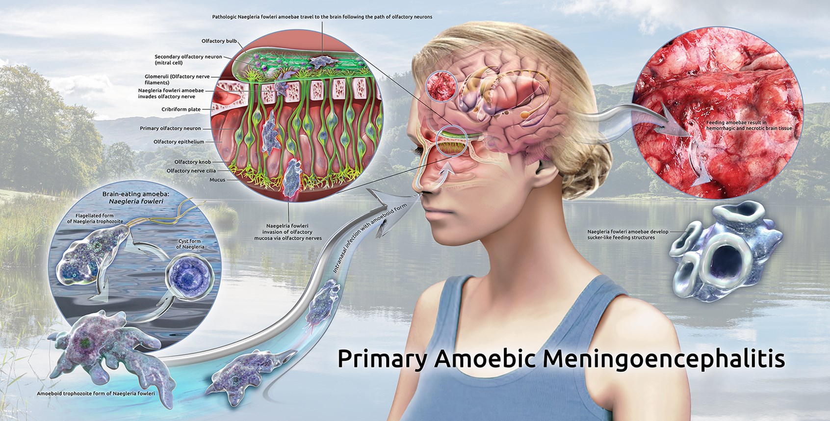 Amoebic Meningoencephalitis in Kerala